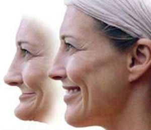 An illustration of the damage done by facial collapse using two pictures of a woman, one before and one after