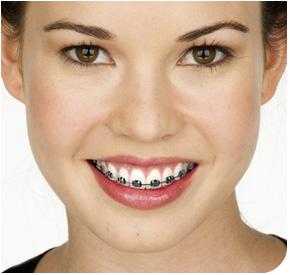 Smiling young woman with braces