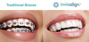 two people smiling. One with traditional braces and one with invisalign