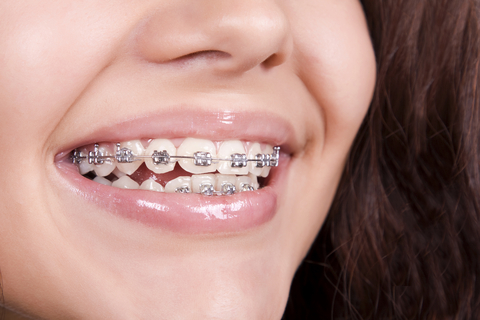 Tulsa braces for othodontic dental treatment