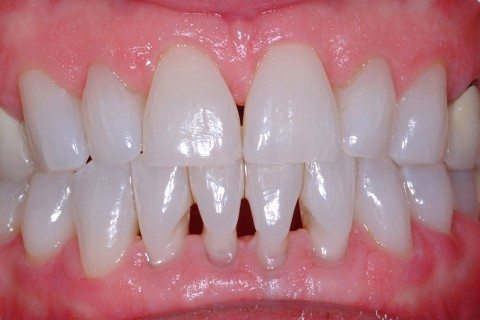 example of black triangles at bottom teeth